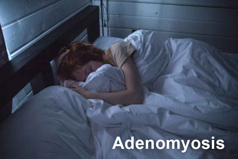 What is Adenomyosis?